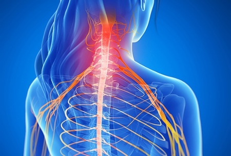 Neck pain Information  Mount Sinai - New York