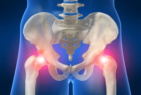 Early Signs of Hip Trouble: Peninsula Orthopedic Associates