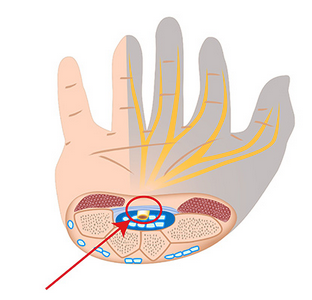 Symptoms of Carpal Tunnel Syndrome