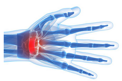 Ultrasound Study for Carpal Tunnel Syndrome - Upper East Side New