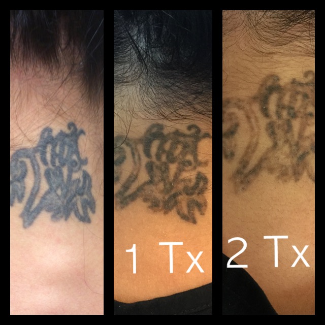 Enlighten Laser Tattoo Removal  Tareen Dermatology  Roseville Minnesota