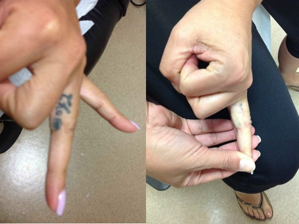 Tattoo Removal Services in Los Angeles Renee Patel, M.D