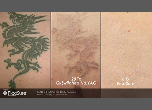 laser tattoo removal specialist park slope brooklyn ny laser tattoo removal specialist park slope brooklyn ny
