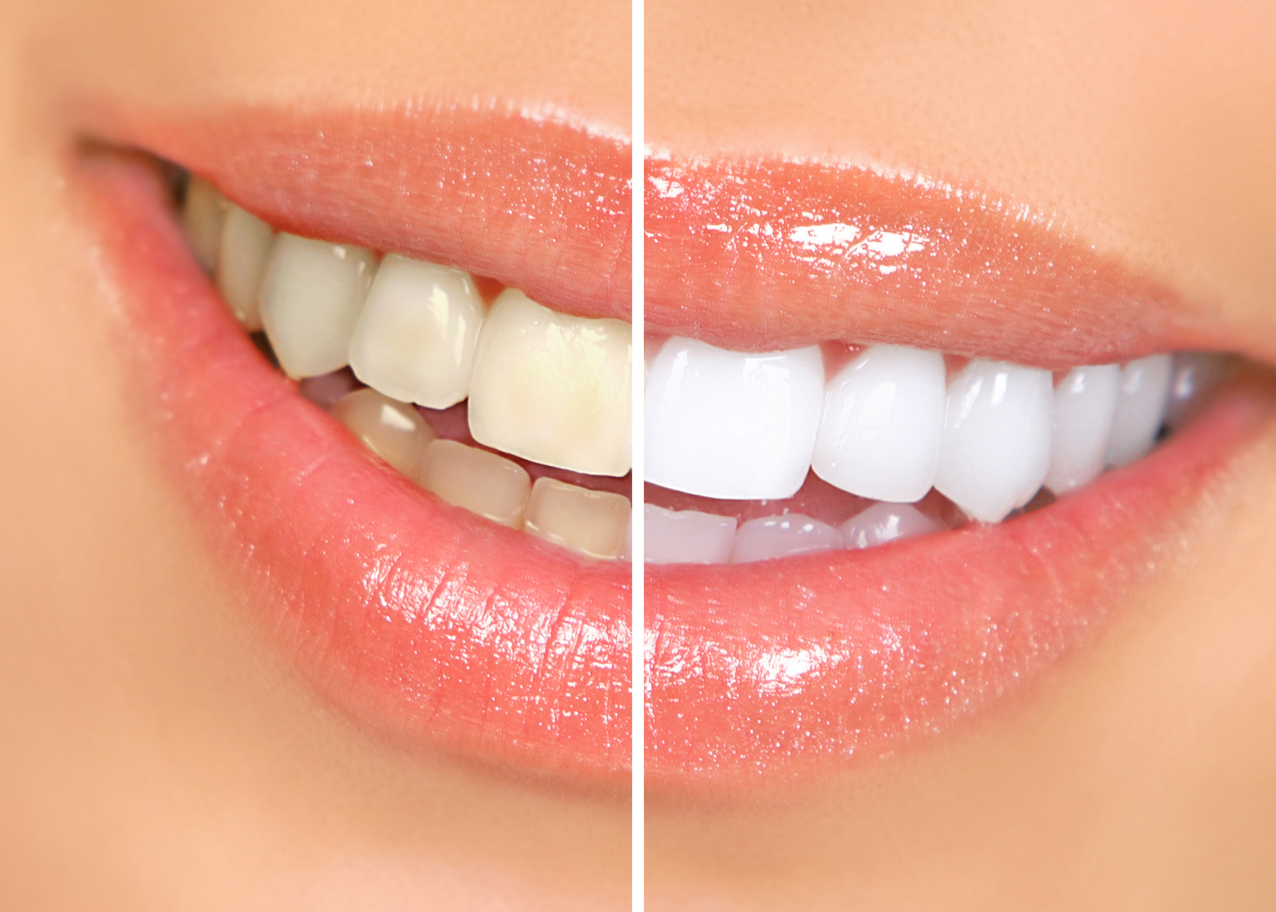 Cosmetic Dentistry Before And After