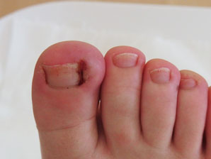 Ingrown Toenails in Fort Myers & Cape Coral, FL