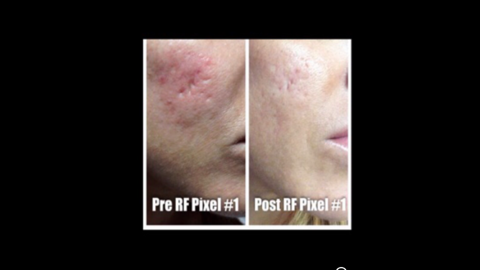 Opus Before & After - Oakbrook Terrace, IL: Advanced Health of Oakbrook