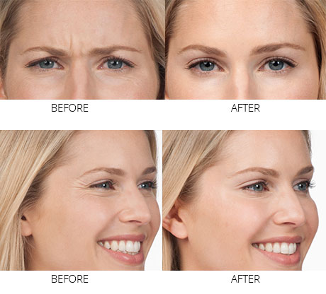botox-img1