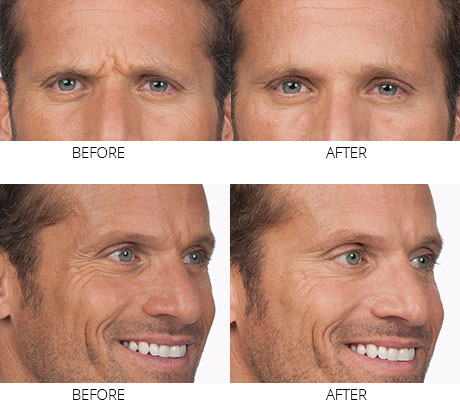 botox-img