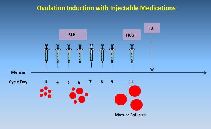 Ovulation Induction Irving Tx And Arlington Tx Ivfmd Fertility Specialist 