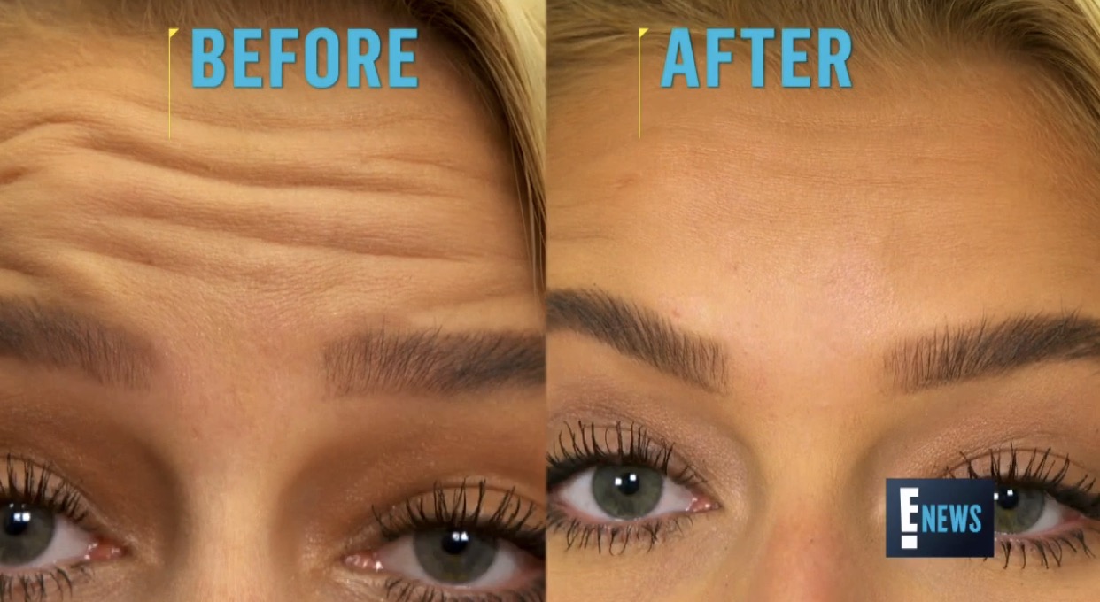 Botox (Anti-Aging) - Beverly Hills, CA: Scarless Nose Institute of