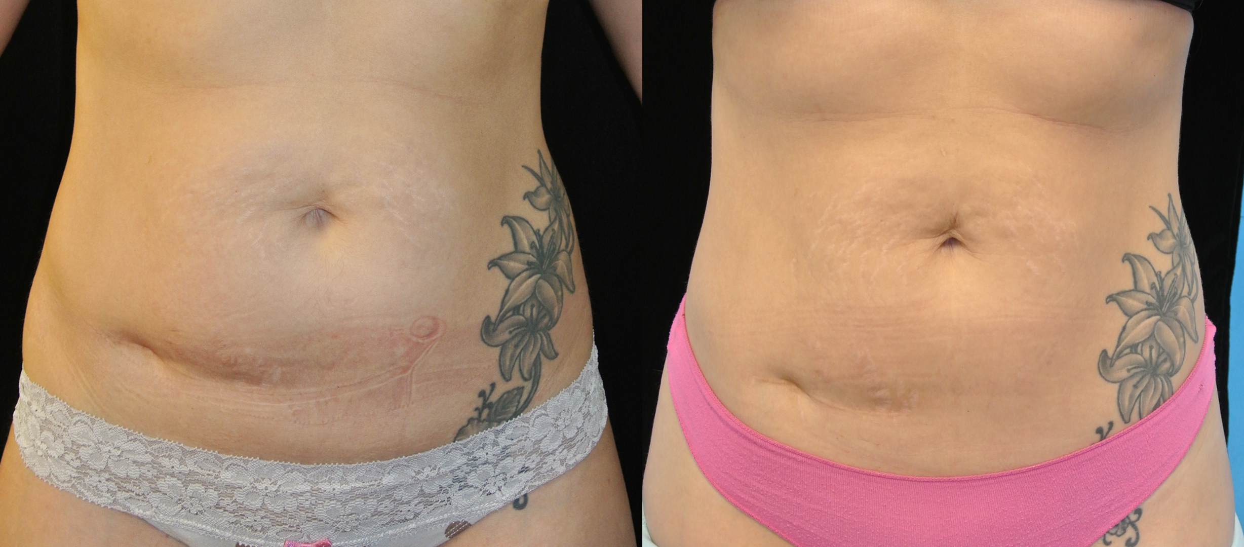 Body Contouring Lasers (Fat Melting) Beverly Hills, CA Beverly Hills