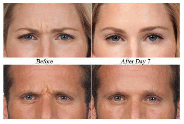 Dentist Appointment After Botox  . By Far, These Are The Two Fastest Growing Cosmetic Treatments I Have Found Now, After Speaking To Thousands Of Dentists Through My Lectures About These Procedures, That We As A Dental Industry Are Pretty Much Ignorant Of.