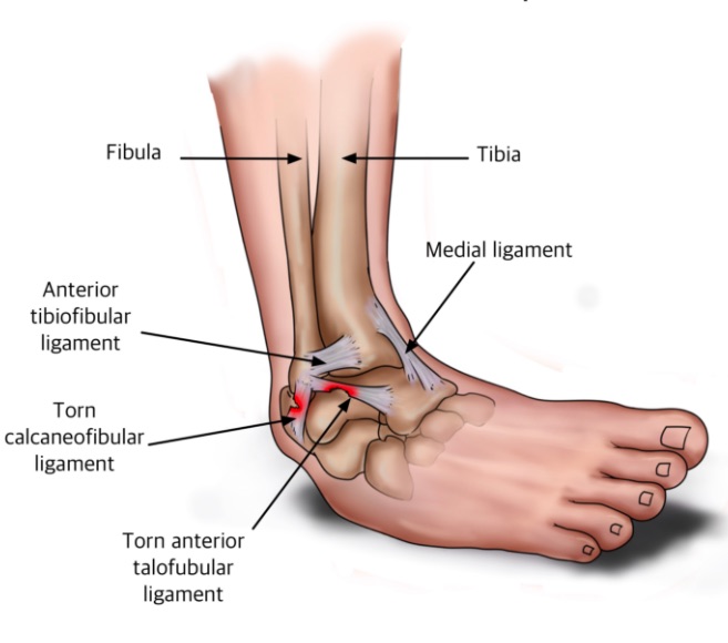 heel hurts after ankle sprain