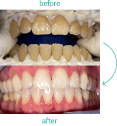 Gum Contouring - Midtown Manhattan New York, NY: New Dimension Dentistry