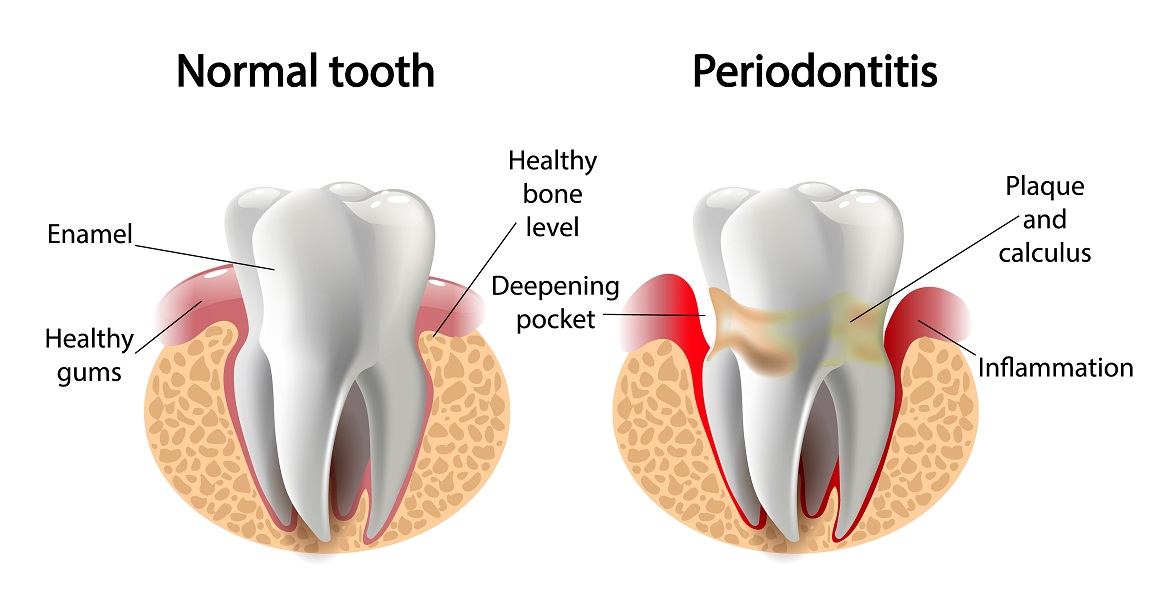 Diagram comparing periodontitis against a normal tooth