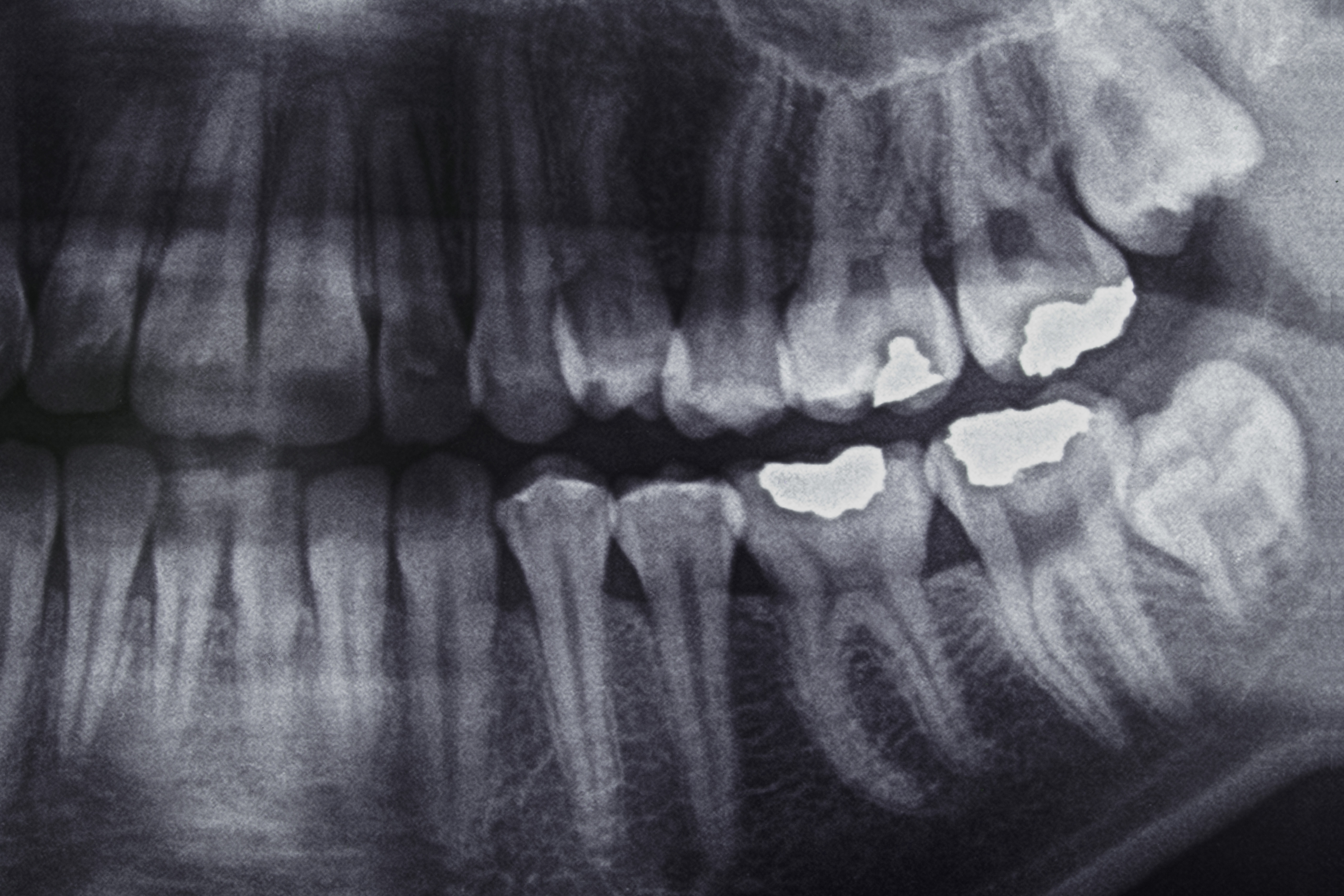 Close up digital x-ray image of teeth accross the jawline