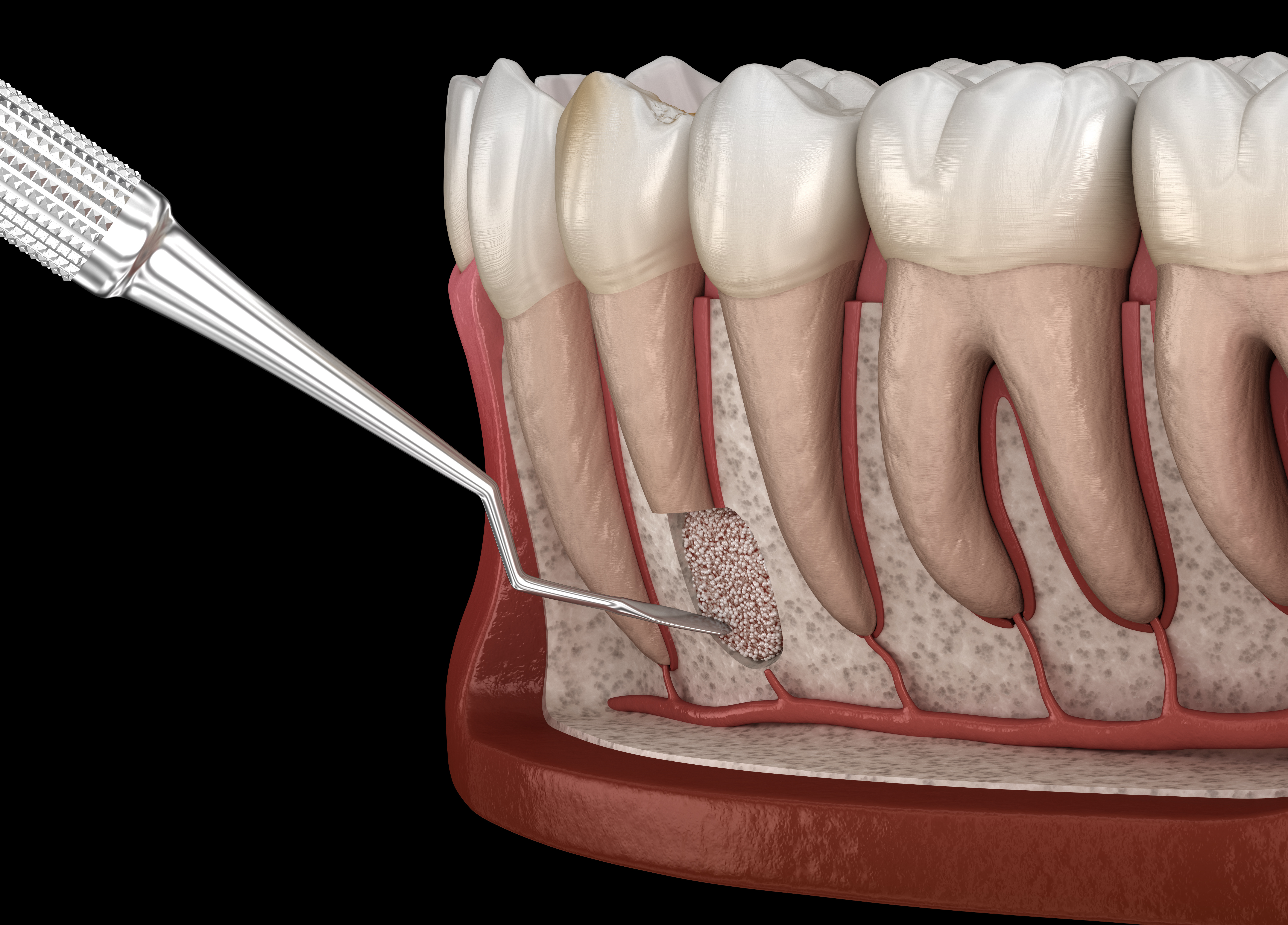 3d illustration of a tooth cystectomy surgery