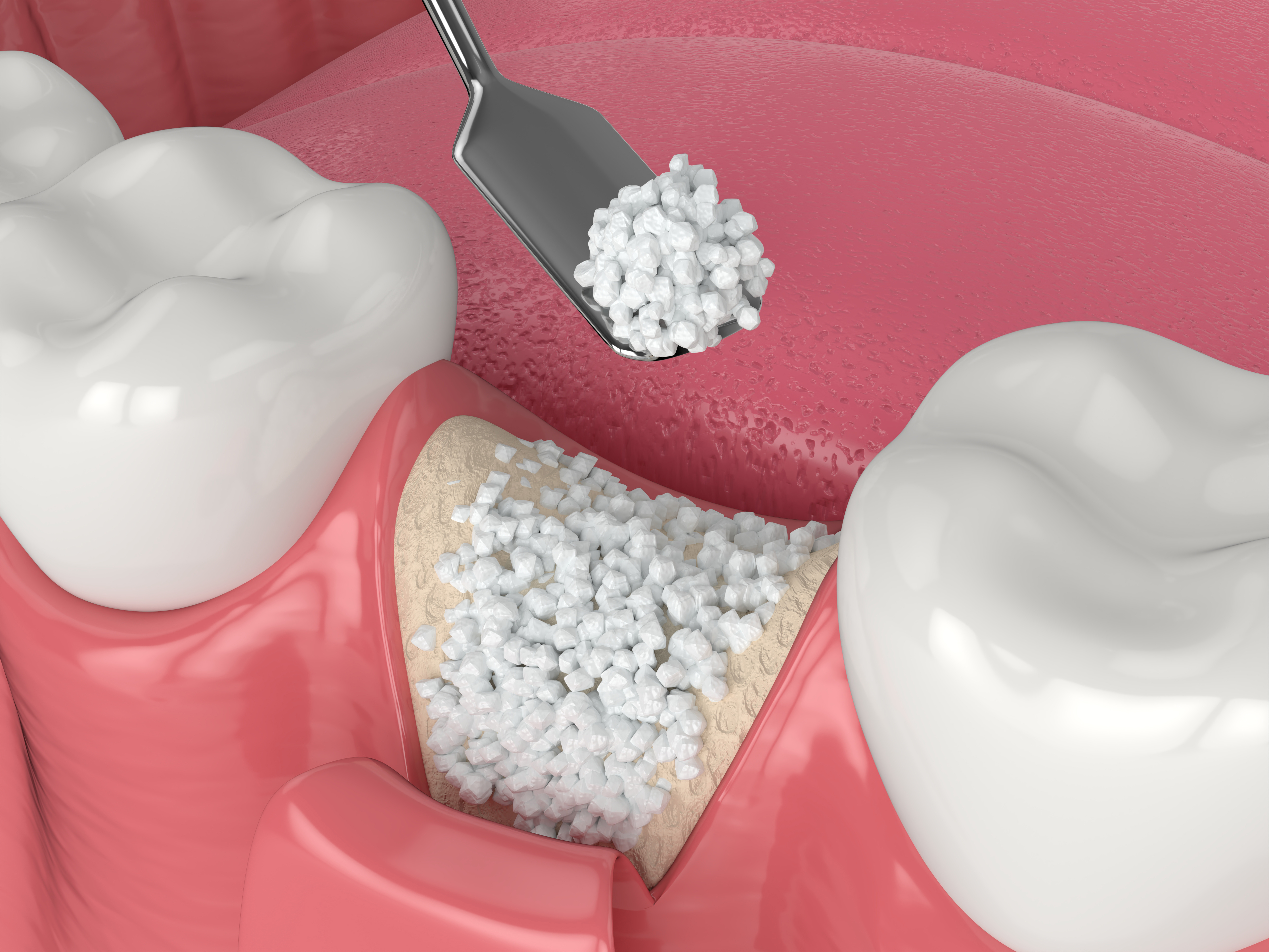 Medically accurate 3D illustration of a bone graft