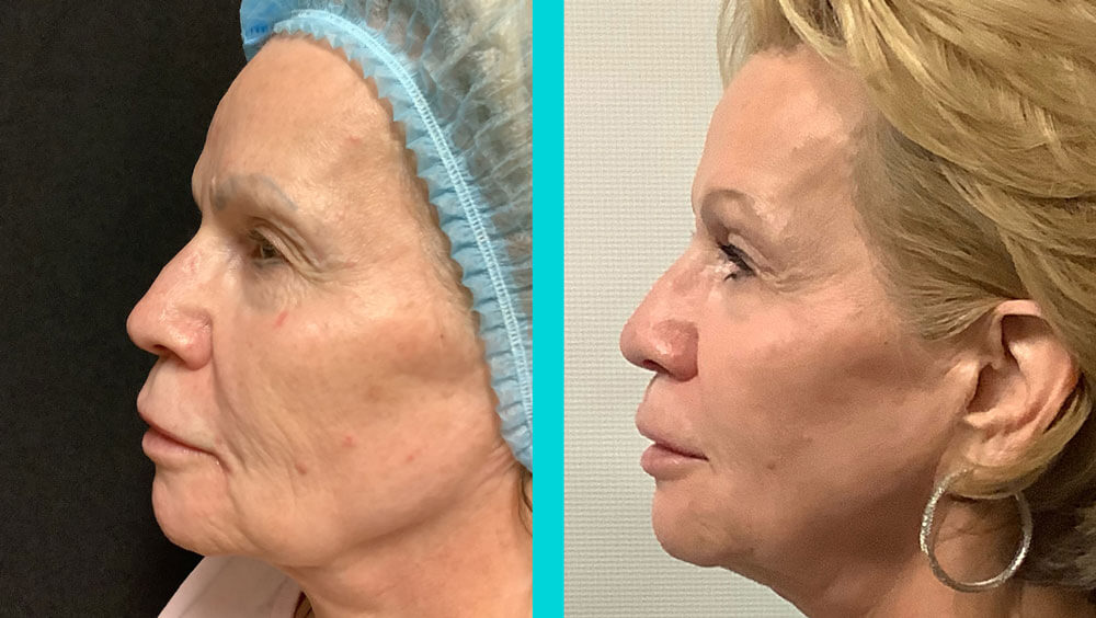 Before & After