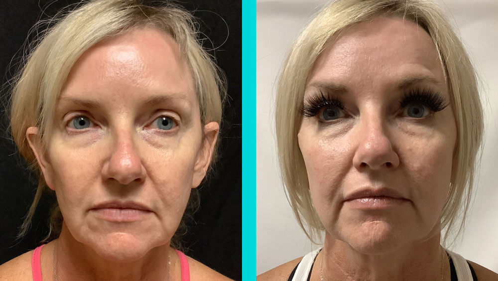 Before & After