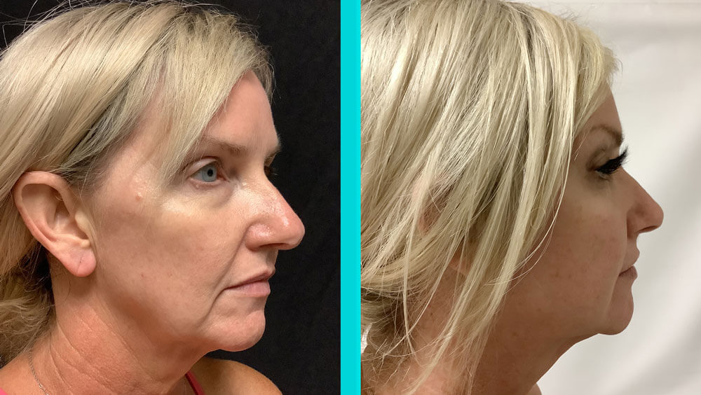 Before & After
