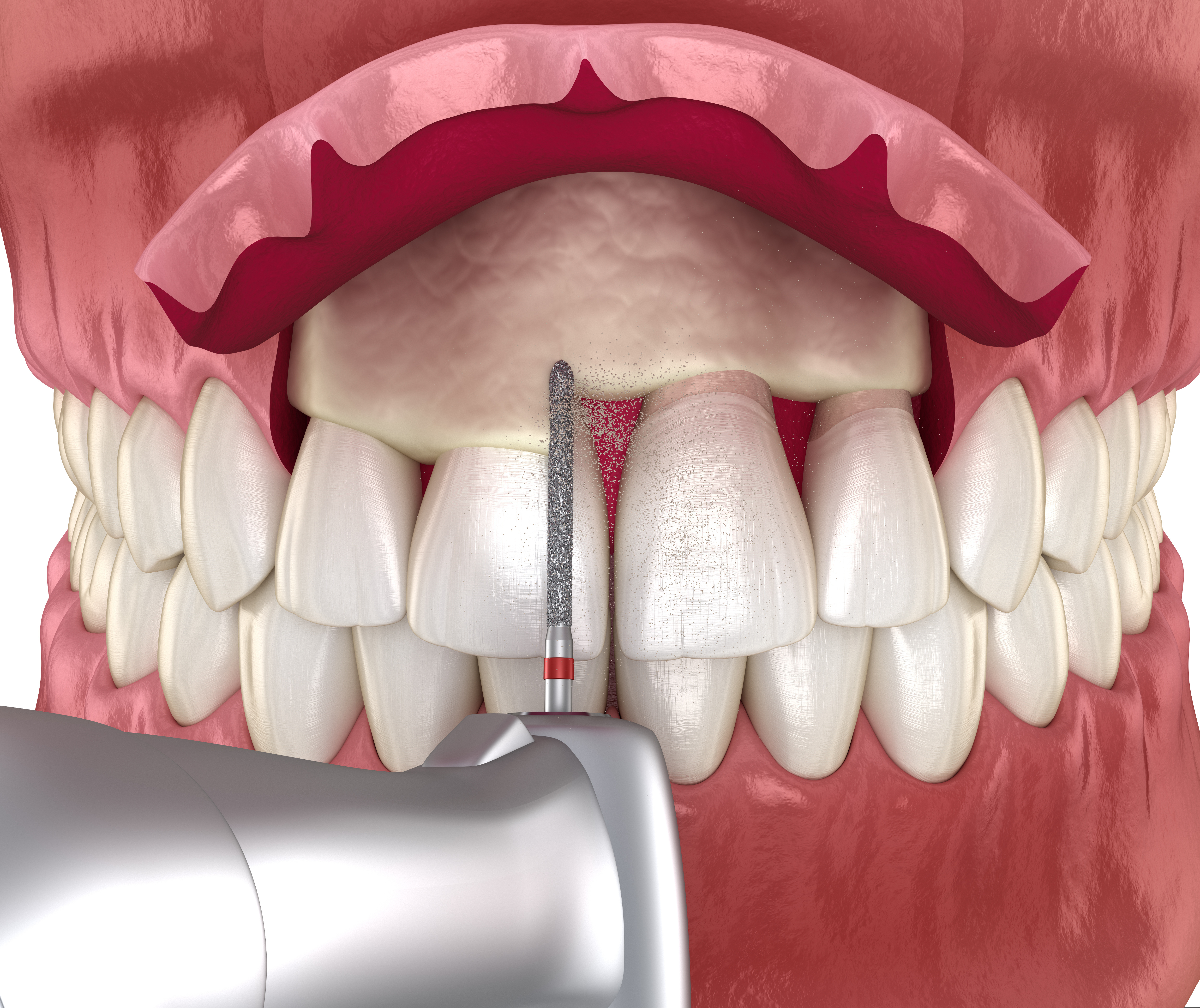 3d illustration of a Frontal crown lengthening