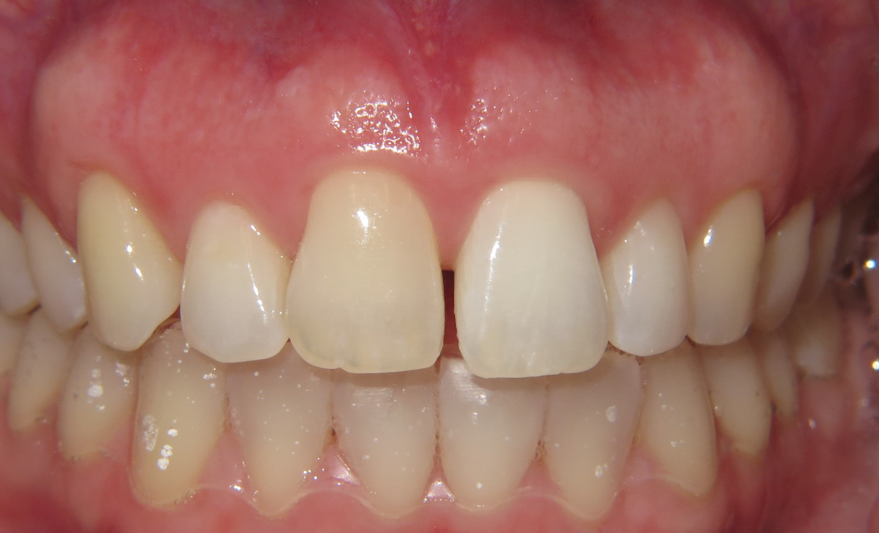 Intracoronal Bleaching for Kirkland, WA Prime Endodontics Endodontists
