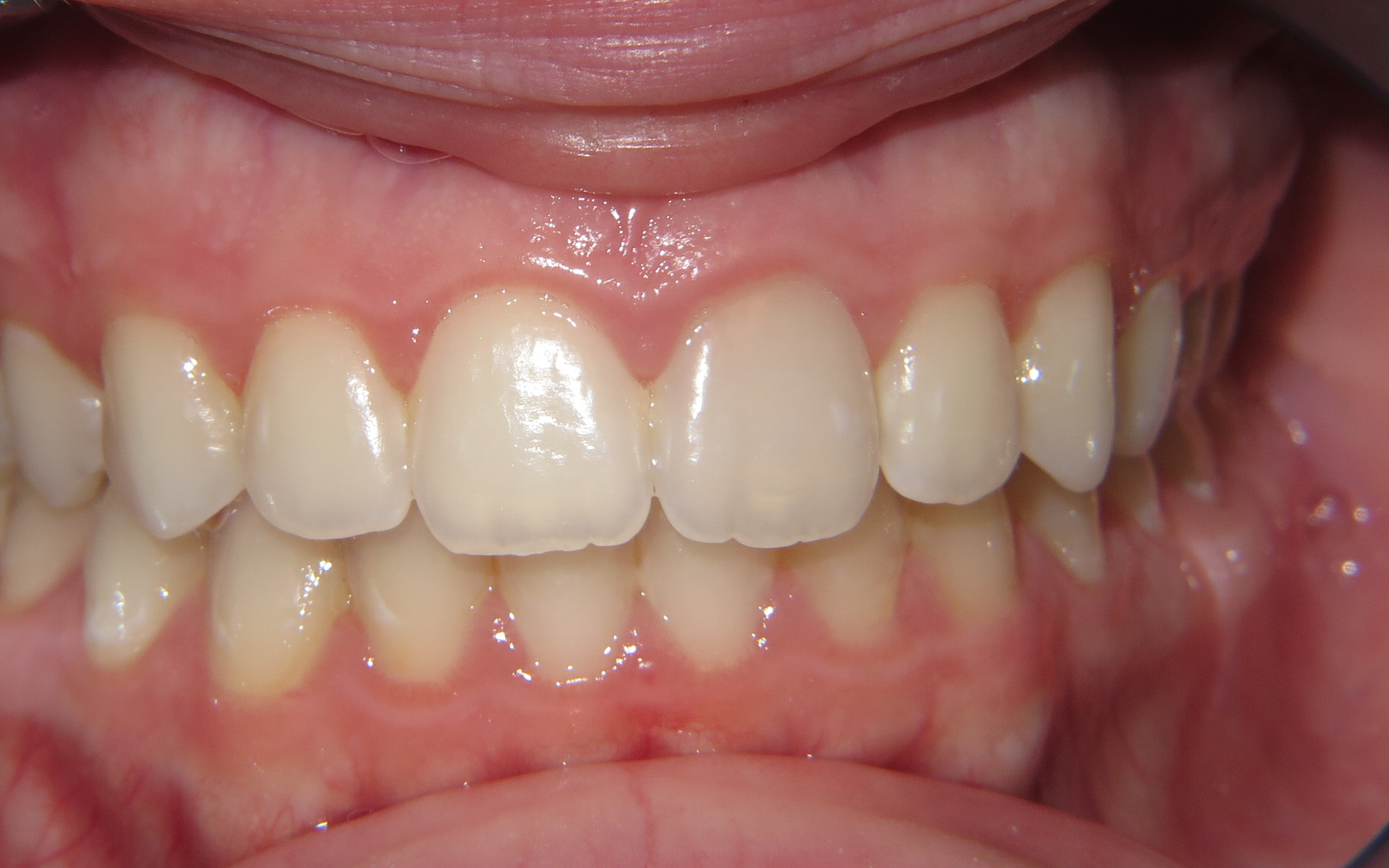 Intracoronal Bleaching for Kirkland, WA Prime Endodontics Endodontists