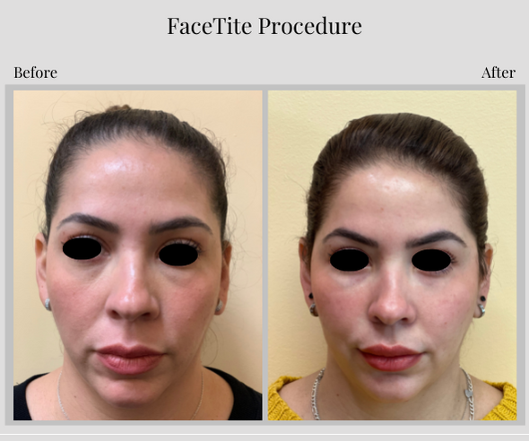 before and after