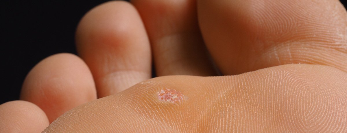 Plantar Wart Removal Cryotherapy | Bruin Blog