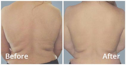 CoolSculpting® Body Contouring