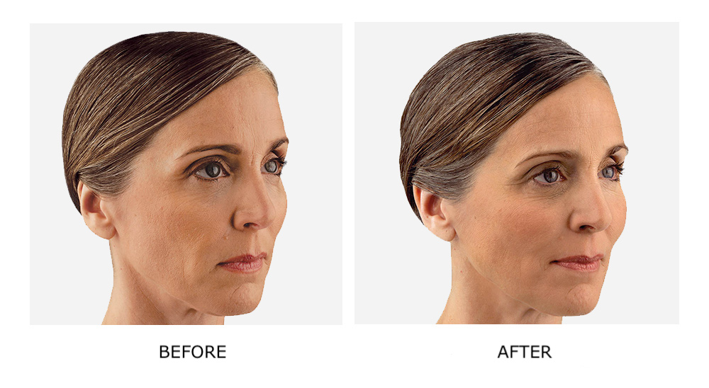 Injectables & Fillers Before & After Photos