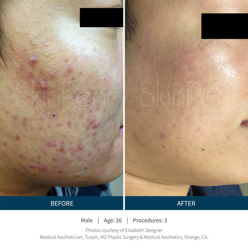 SkinPen™ Before & After Photos