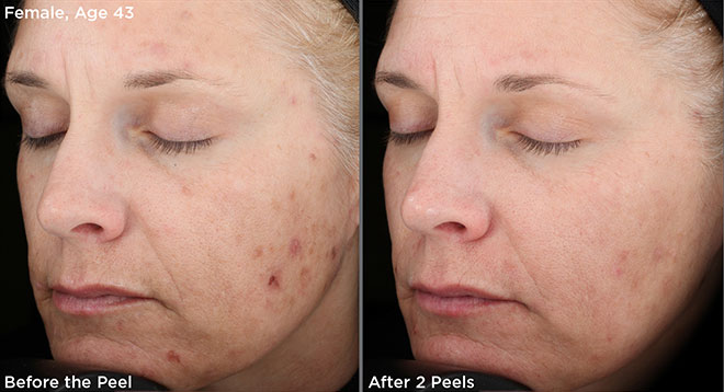 Vitalize Peel by SkinMedica®