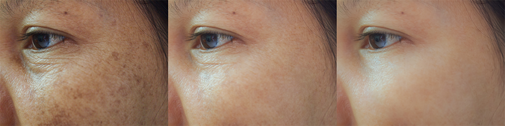 Age Spots