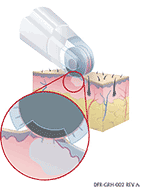 DermaFrac Micro Needling Skin Rejuvenation