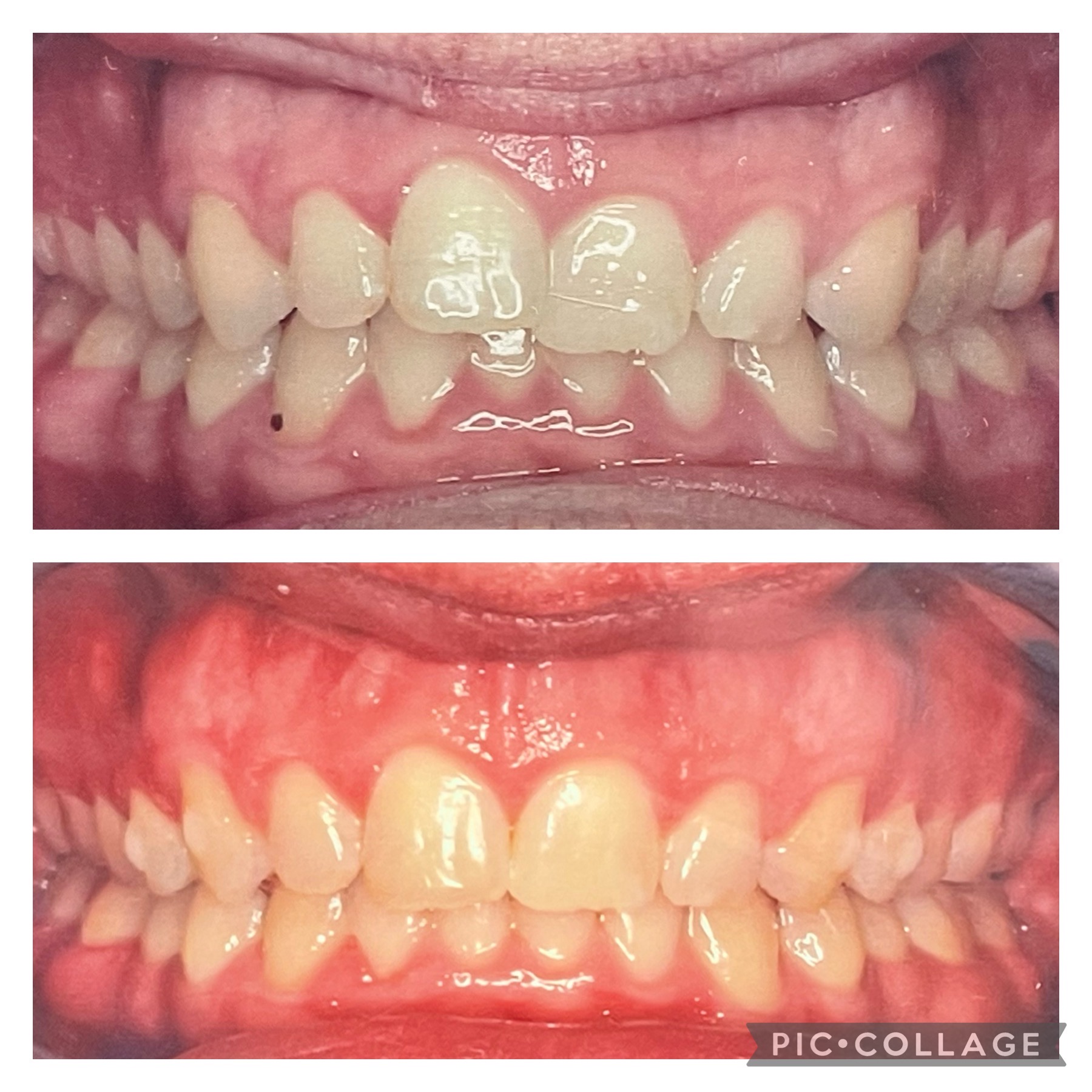 Invisalign before after