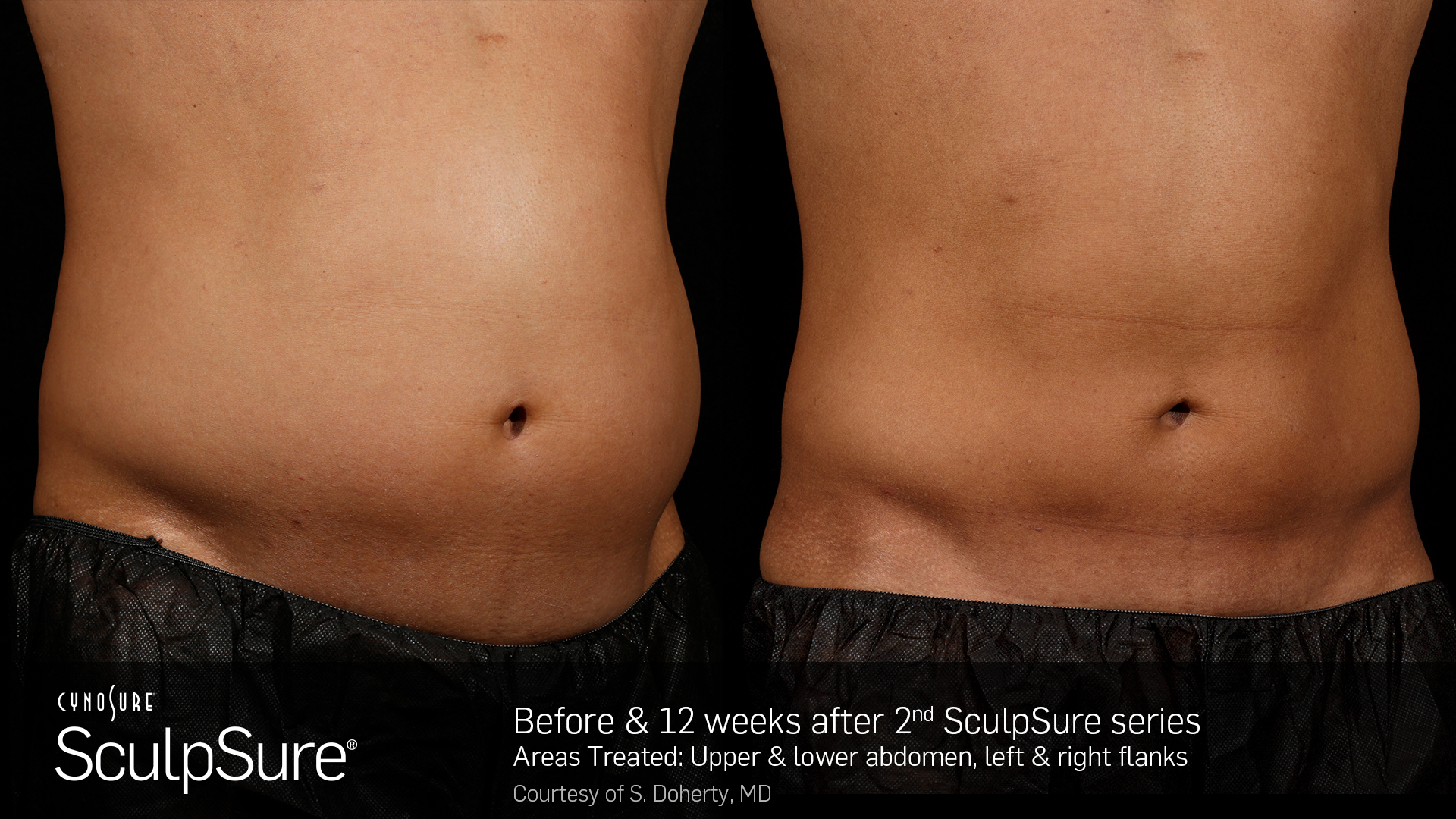 Before and After Photos