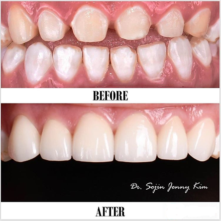 Cosmetic Crowns