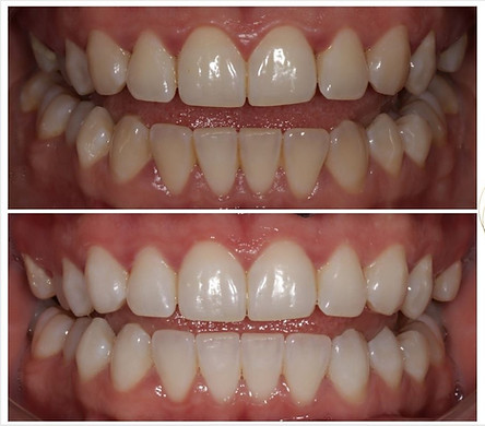 Teeth Whitening