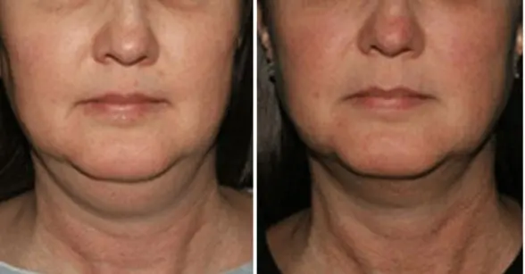 Kybella®