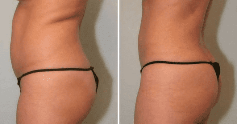 SmartLipo™ Results