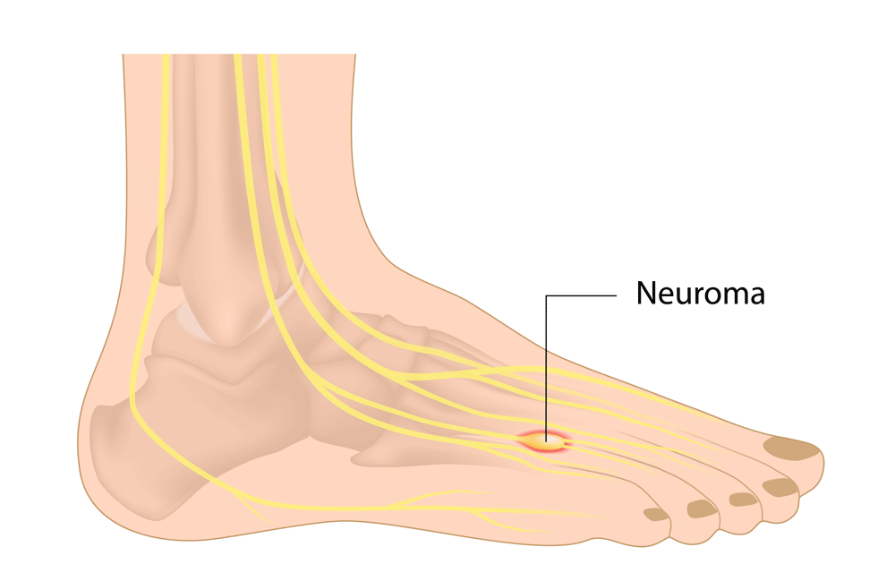 morton's neuroma