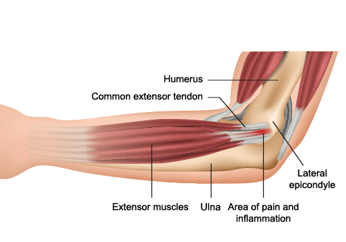 tennis elbow