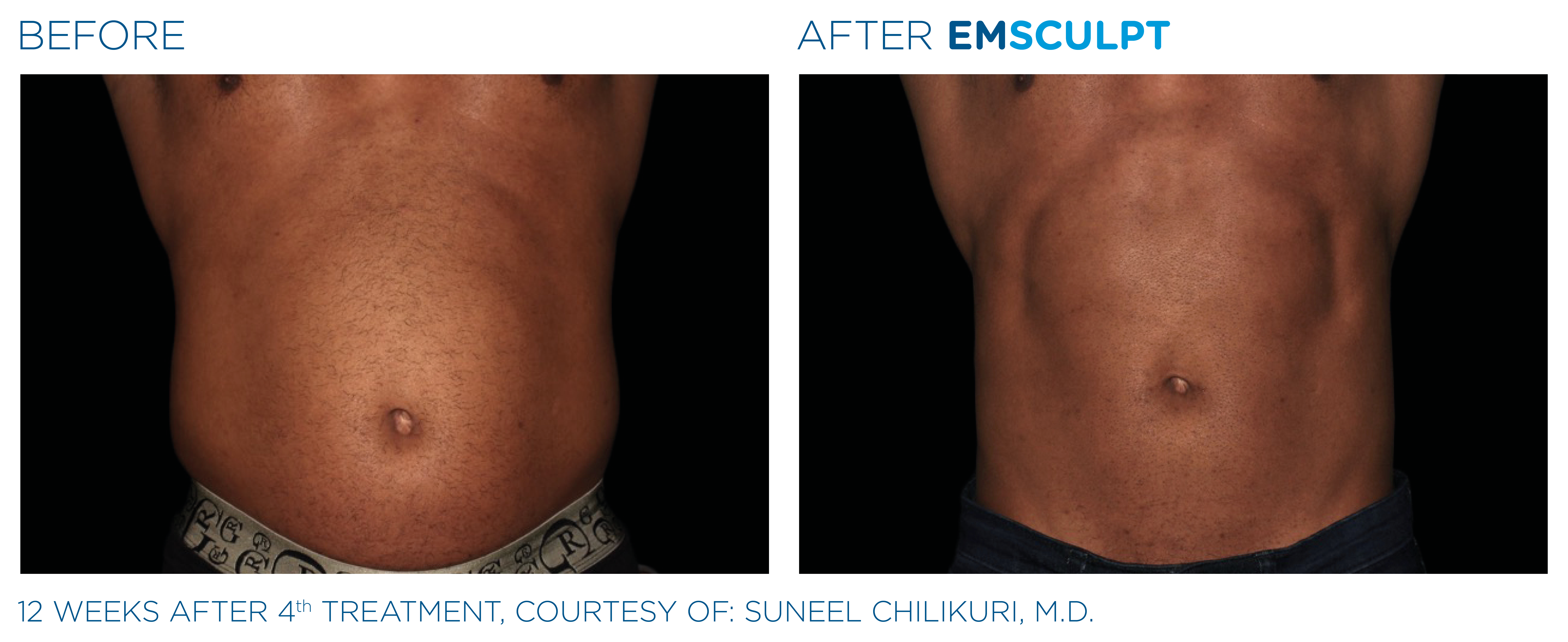 Emsculpt Treatment Near Me in Encino, CA