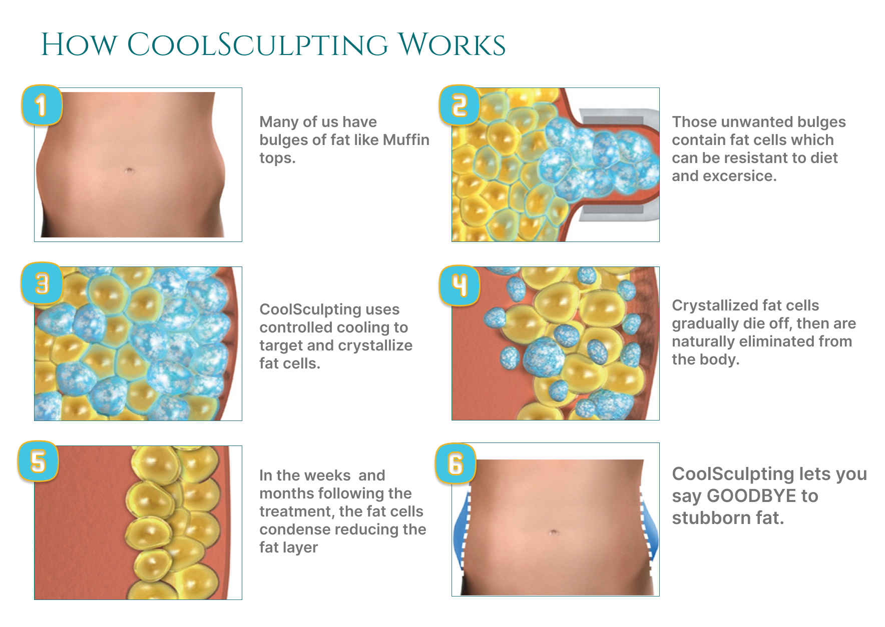 CoolSculpting: Does it work and is it safe?