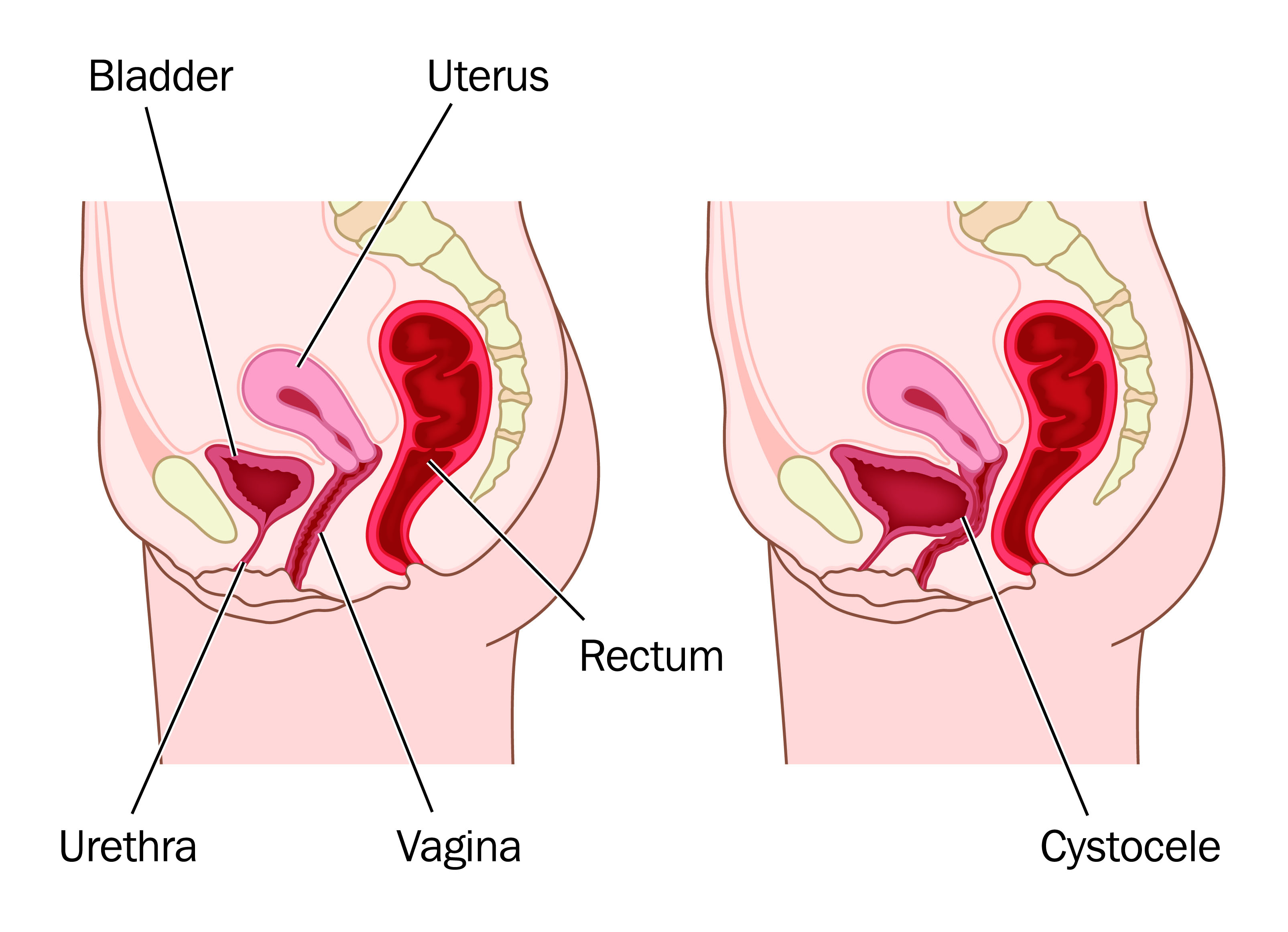 Recurrent Urinary Tract Infections? It May Be Pelvic Floor