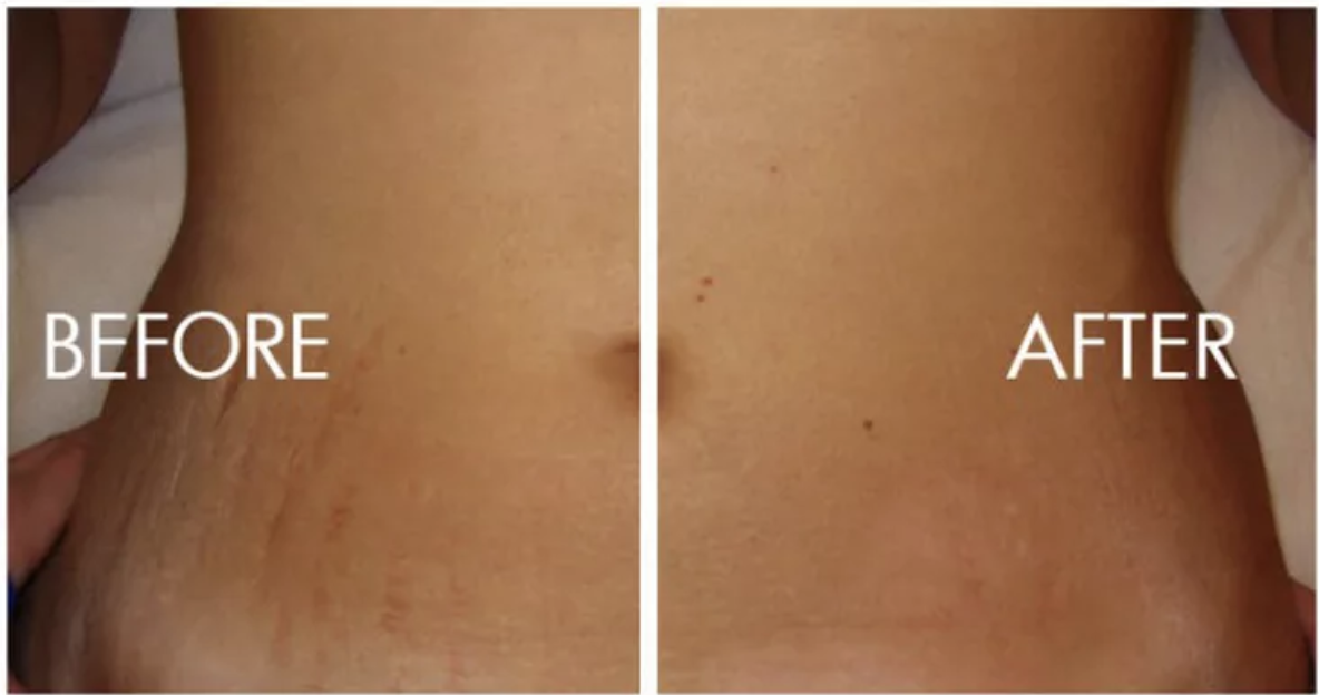 Laser Stretch Mark Removal Specialist Spring Tx Hidden Beauty Retreat Medspa Laser Center