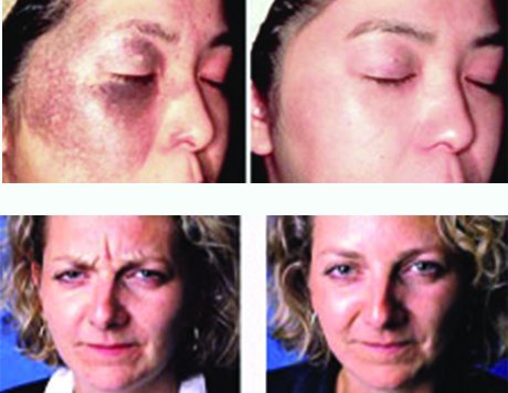 Morris Westfried, MD: Dermatologist |Brooklyn, NY