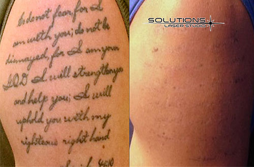 before and after galleries naperville il solutions before and after galleries naperville il solutions